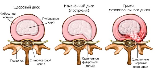 История болезни поясничный остеохондроз грыжа диска корешковый синдром