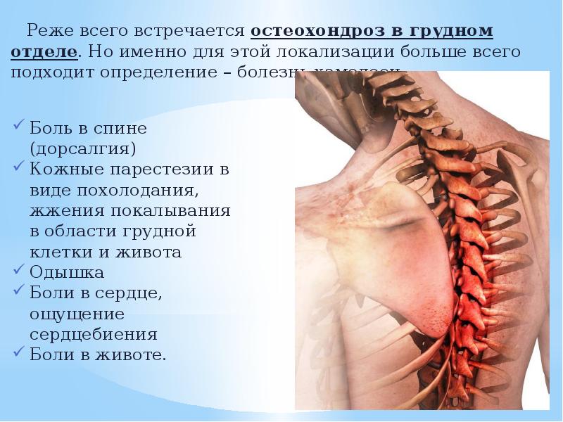 Остеохондроз корешковый синдром поясничного отдела