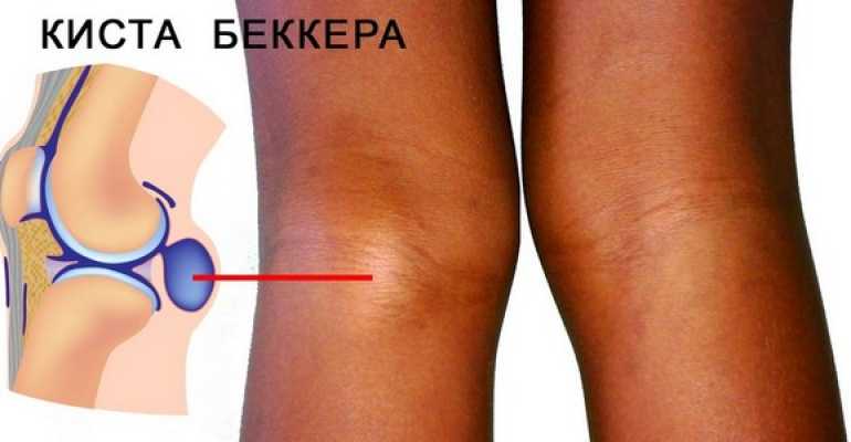 Изображение - Боль и жжение в коленном суставе kista-bekkera