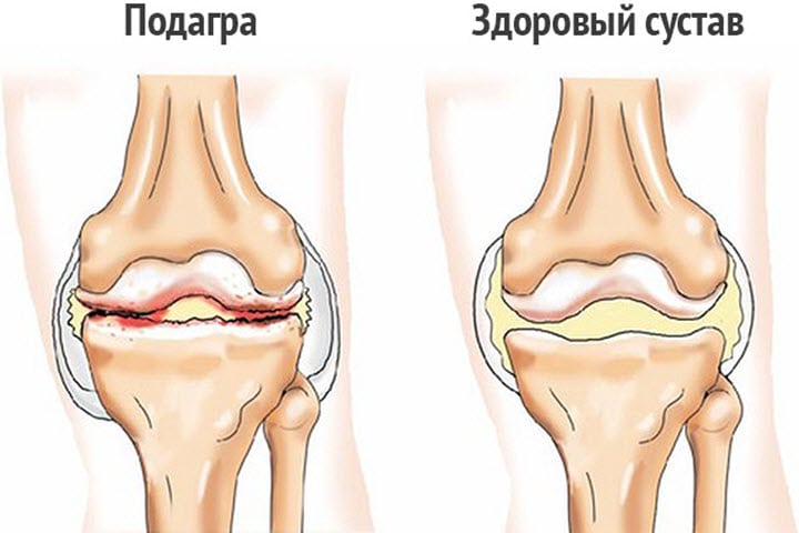 Изображение - Боль и жжение в коленном суставе podagra-kolena