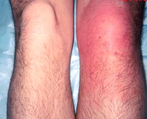 Инфекционный артрит коленного сустава симптомы лечение
