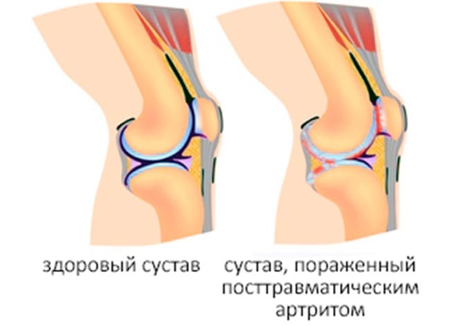 Септический артрит коленного сустава