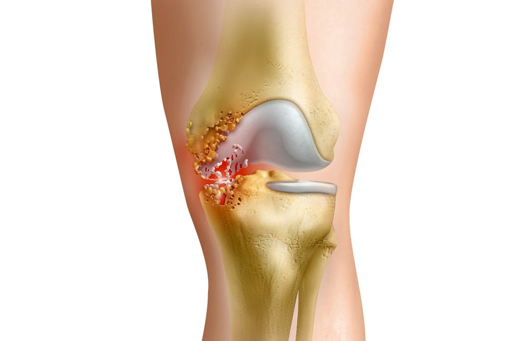Бактериальный артрит коленных суставов