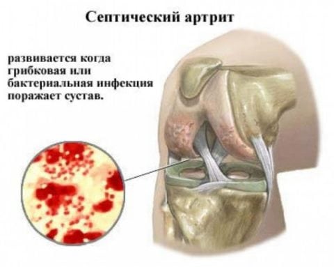 Инфекционный артрит коленного сустава
