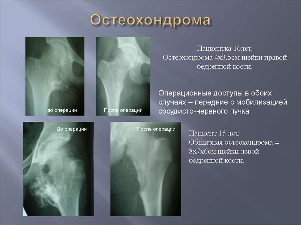 Остеохондрома бедренной кости лечение народными средствами thumbnail