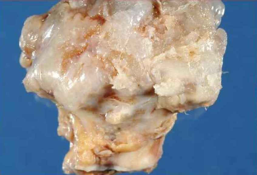 Остеохондрома бедренной кости противопоказания