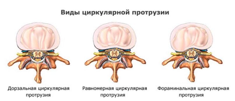 Циркулярная протрузия шейного отдела позвоночника