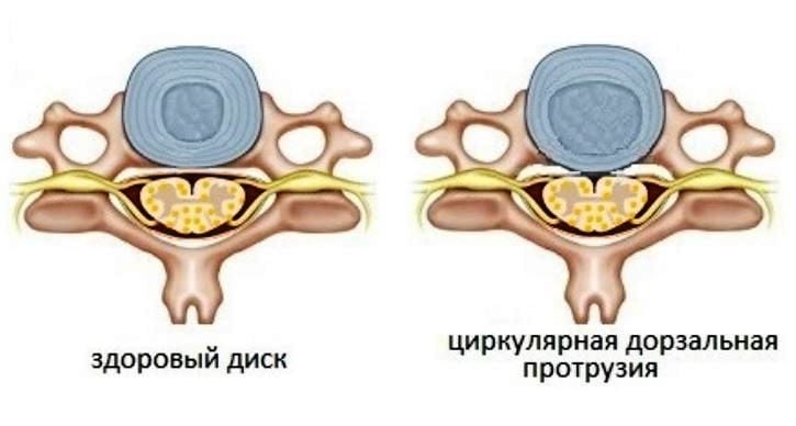 Циркулярная протрузия дисков шейного отдела позвоночника