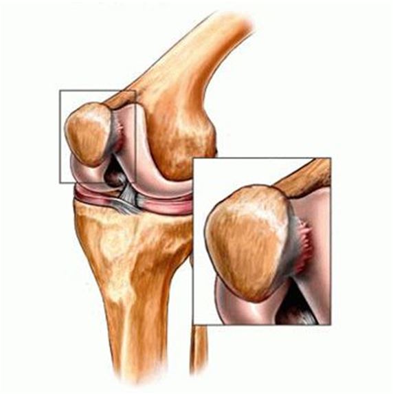 Лечение хондропатия коленного сустава