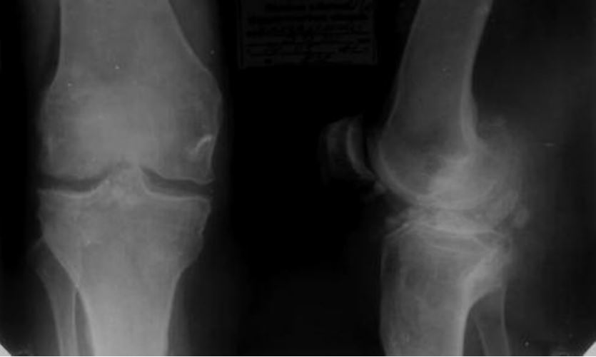 Хондроматоз коленного сустава симптомы лечение
