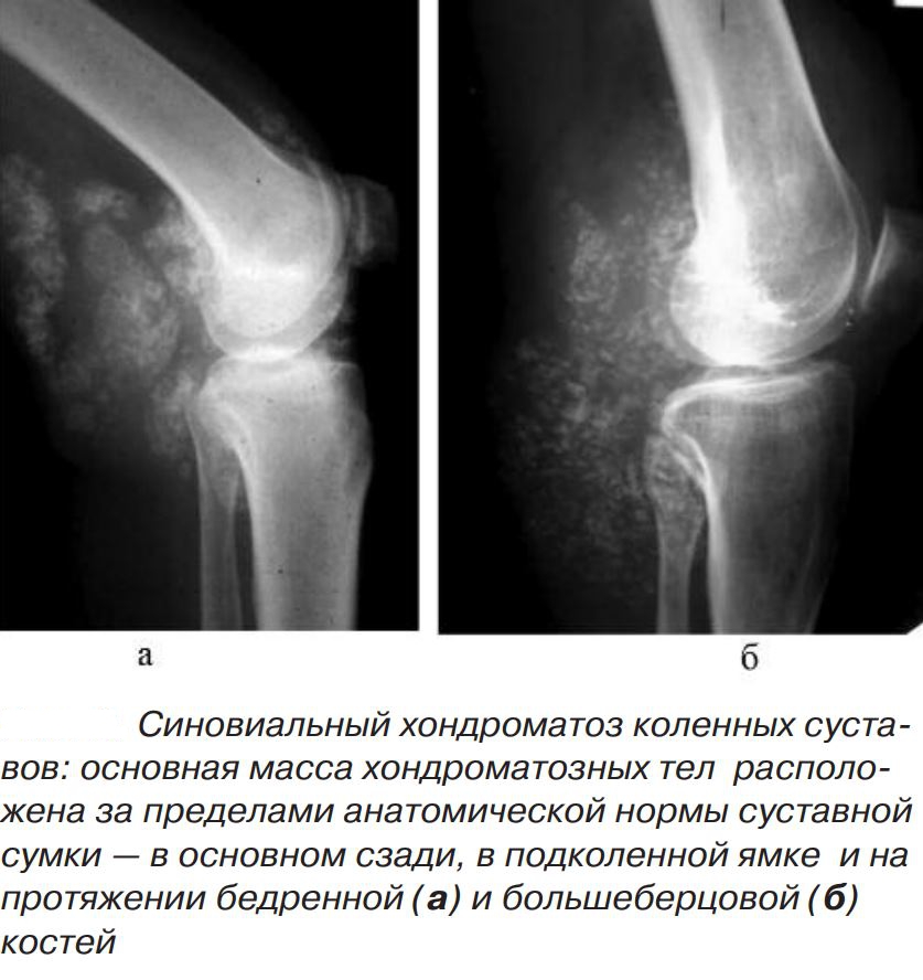 Остеохондроматоз коленного сустава лечение