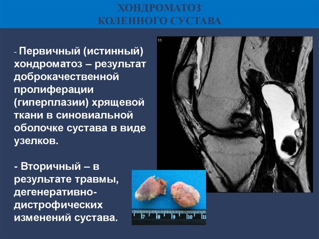 Хондроматоз коленного сустава лечение после артроскопии